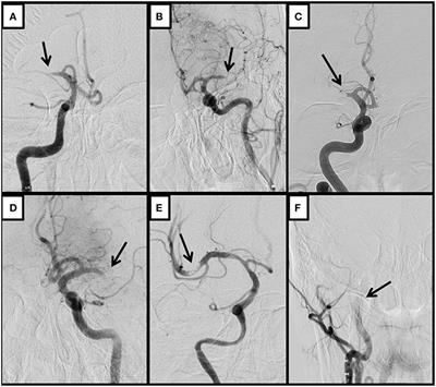 Baseline Occlusion Angiographic Appearance on Mechanical Thrombectomy Suggests Underlying Etiology and Outcome